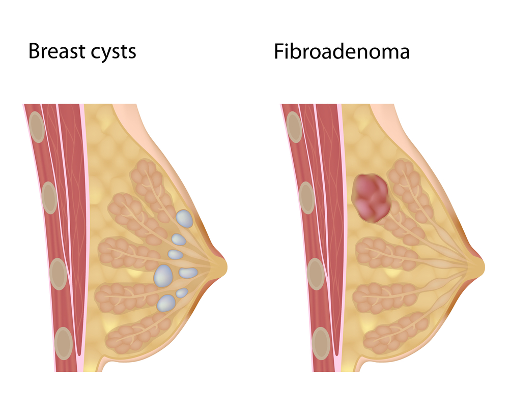 Фиброаденома молочной железы