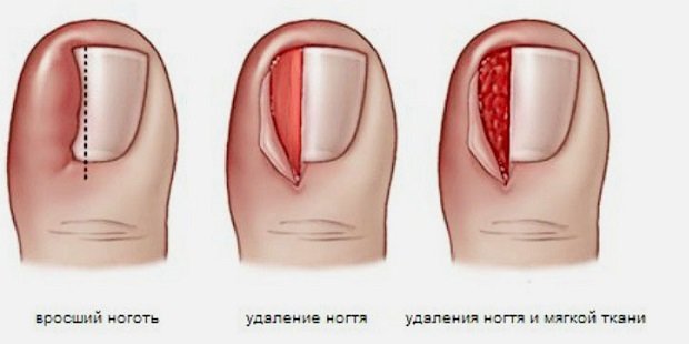 После лазера ноготь врастает в палец После лазера ноготь врастает в палец