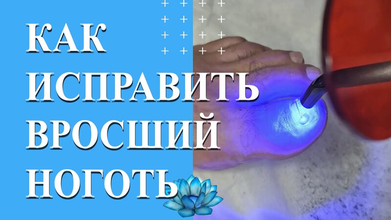 Лечение ногтей на ногах. Реальное удаление вросшего ногтя. - Смотреть ...