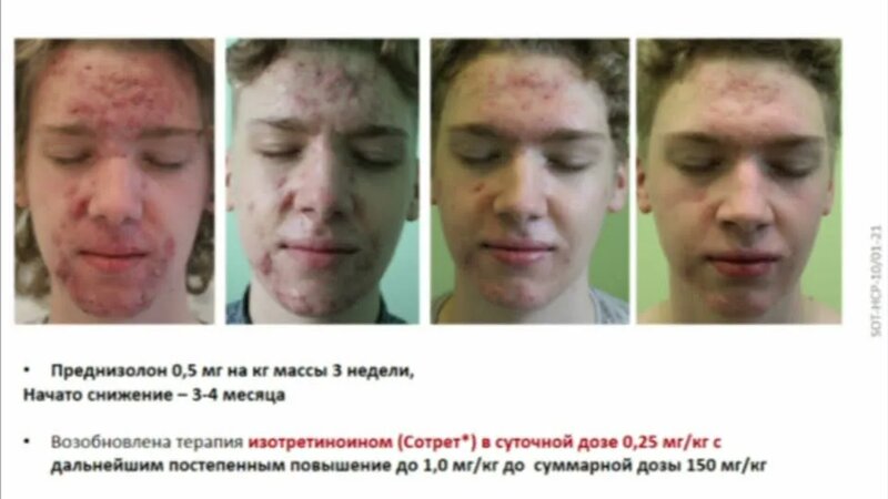 Тяжелая форма акне. Системная терапия - Смотреть онлайн в поиске ...