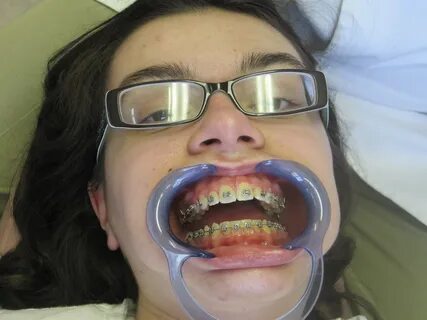 Planet Parenting: Horrors of Orthodontia