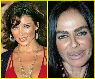 10 Celebrity Plastic Surgery Disasters Before and After Cele