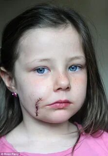 Dog scars five-year-old*s face in savage attack in Yorkshire