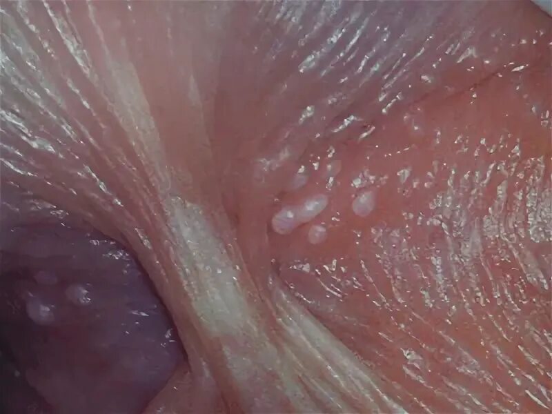 frontière traitre insecte small white spots on penile shaft 