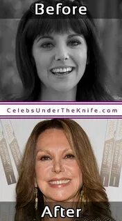 Marlo Thomas Plastic Surgery Photos? Before + After Her Nose