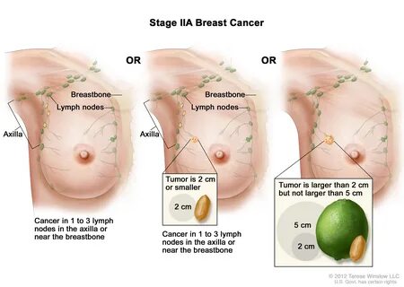 Breast Cancer Treatment During Pregnancy Pdq Patients Siteman Cancer Center...