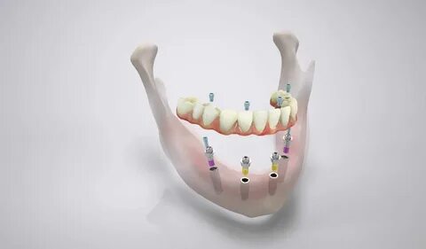 Fester Zahnersatz auf 4 - 6 Implantaten an einem einzigen Ta