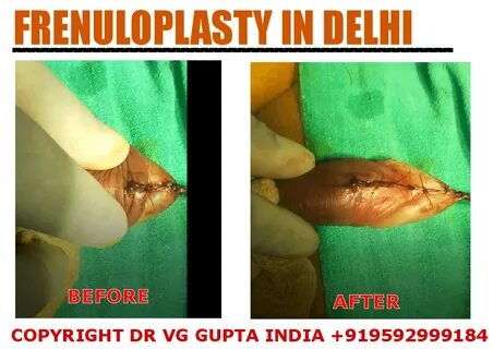 Frenuloplasty cost in India Tight frenulum treatment in New 