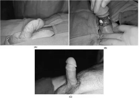 Management of Peyronie's disease with penile prostheses Inte