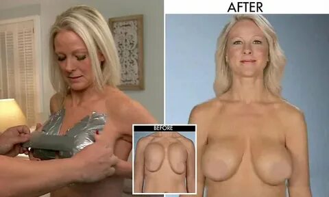 US mother on E's Botched had to tape breasts during sex