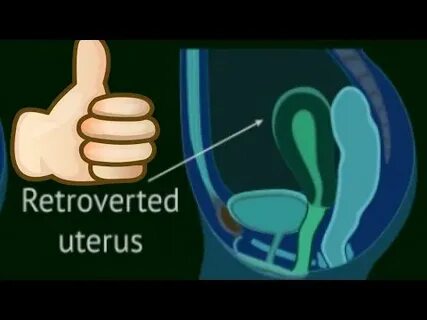 retroverted uterus - YouTube