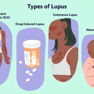 Eat This Not That: Lupus And Periods