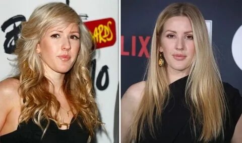 Ellie Goulding Before And After Surgery - biomassdesigns