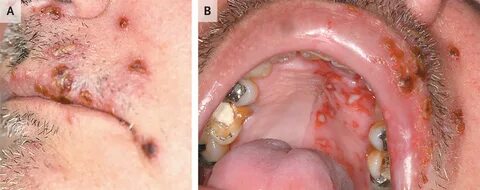Symptome herpes mundwinkel falten, oral herpes treatment cre