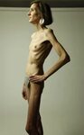 Very skinny anorexic girl nude - Hotnupics.com