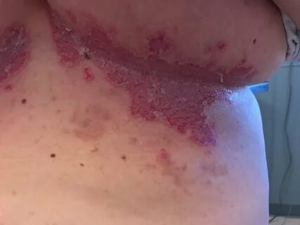 Rash under boobs