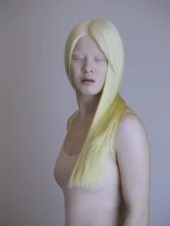 Albino and Beautiful - Creative Insights - Getty Images