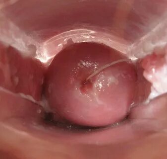 Age 25 - Entire Cycle, IUD Beautiful Cervix Project