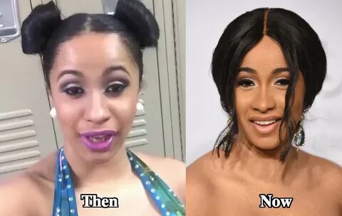 Cardi-B-Teeth-before-and-after-surgery