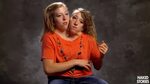 Siamese twins brittany and abby Conjoined Twins Brittany and