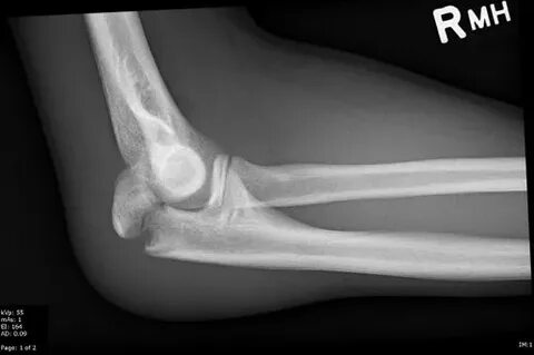 File:Olecranon Fracture.jpg - Wikipedia