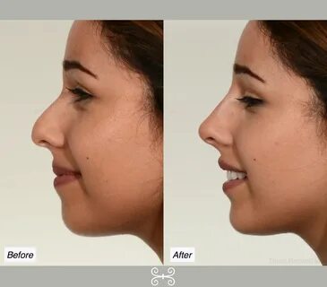 non surgical nose job - Charleston Facial Plastic Surgery