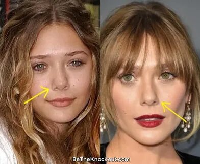 Elizabeth Olsen Plastic Surgery Comparison Photos