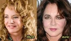 Stockard Channing Plastic Surgery Before and After - Plastic