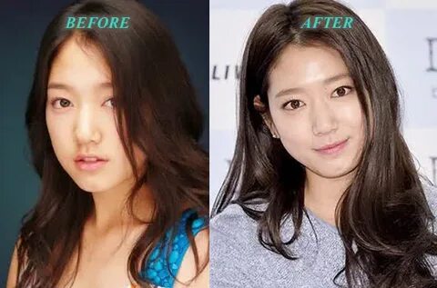 Park Shin Hye Plastic Surgery Before and After