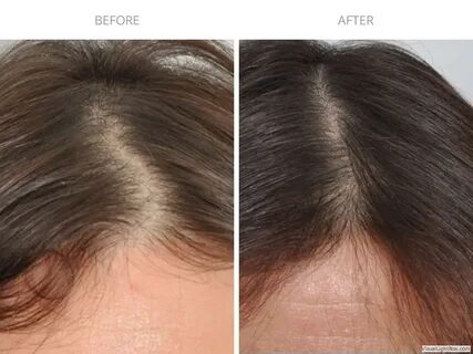 PRP Hair Treatment Before/After Photo Gallery HairCareMD NYC