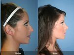 Before & After Nose Job Nose job, Nose surgery, Plastic surg