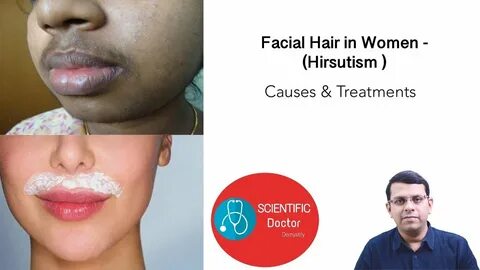 Download Hirsutism II Abnormal facial hair growth in female