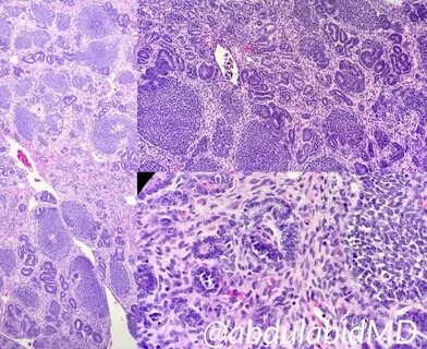 Texas Soc of Pathol on Twitter: "Wilms Tumor Malignant embry