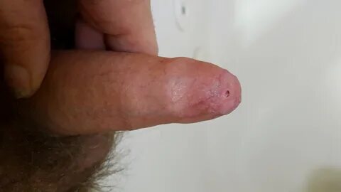 Pictures of my penis A Phimosis Journey