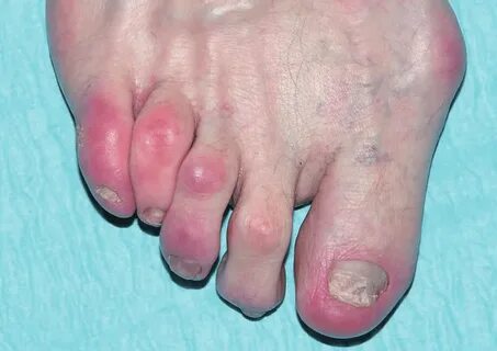 Zehen Raynaud Syndrom Füße - Tulisa Hensley