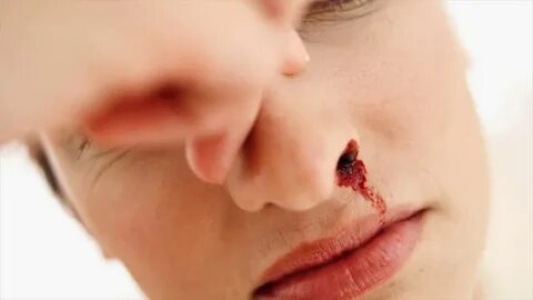 What Nose Bleeding Is- What Causes Nose Bleeding - YouTube