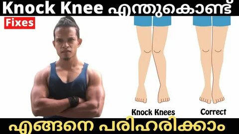 What is Knock Knee? knock knees Causes How to Correct Knock 