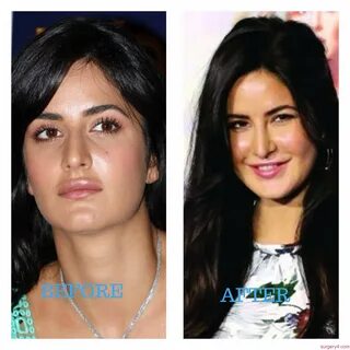 Katrina Kaif Plastic Surgery Photos Before & After - Surgery