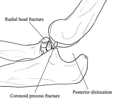 Terrible Triad Injury of Elbow - Trauma - Orthobullets