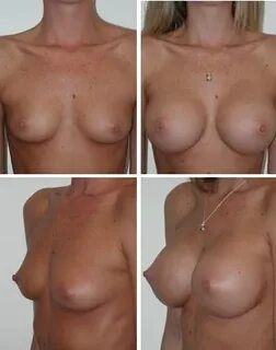 Before After Boob Job Nude