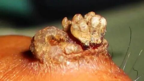 Plantar Wart Definition, Treatment and Removal! - YouTube