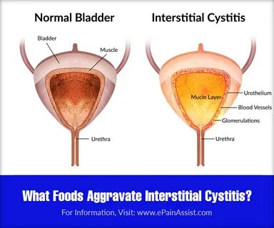 What Foods Aggravate Interstitial Cystitis & What Foods Calm