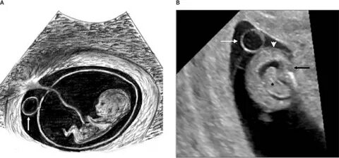 5 Weeks Pregnant Ultrasound Yolk Sac / First Trimester Scans