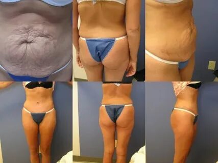 16 days post op tummy tuck - Cosmetic Surgery Tips