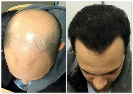 Hair transplantation is a surgical system that expels hair f