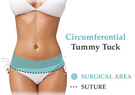 Tummy Tuck - Purpose, Benefits, Cost, Scars, Recovery Time e