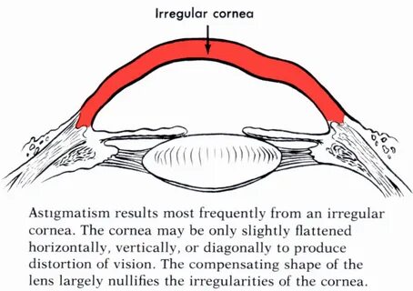 Astigmatism What Related Keywords & Suggestions - Astigmatis