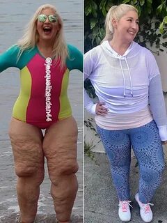 Woman Who Lost 350 Lbs. Says Skin Removal Surgery Isn't an I