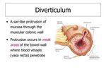 PPT - Diverticular disease PowerPoint Presentation, free dow