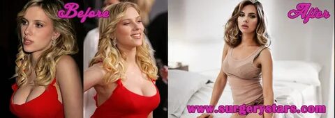 Scarlett Johansson Breast Reduction Photos